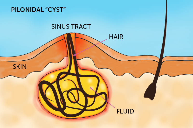 Pilonidal_Cyst_final