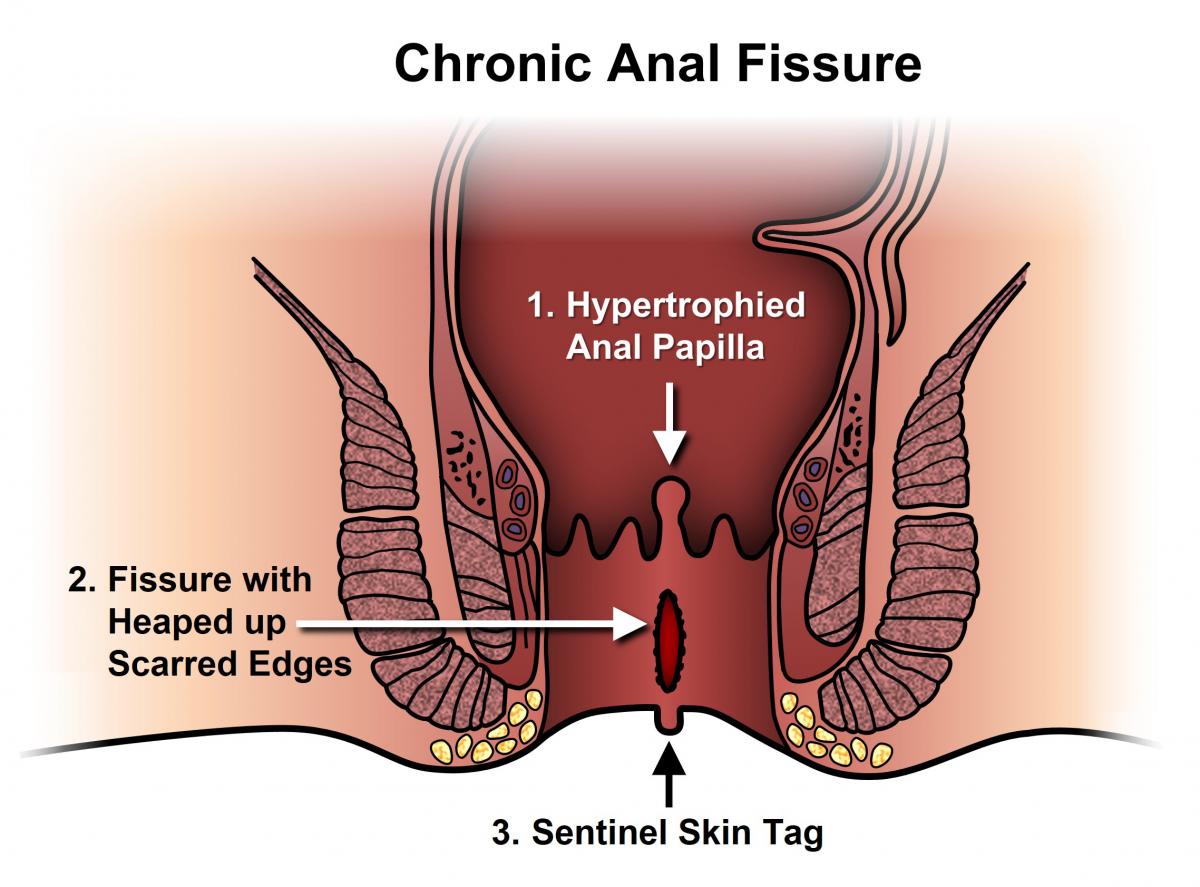 anal_fissure