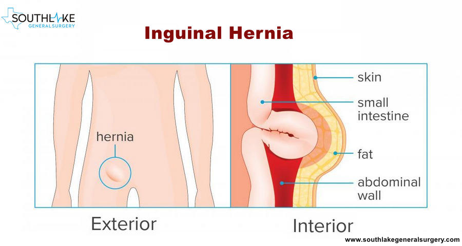 Femoral Hernia Surgery at Southlake General Surgery - Southlake