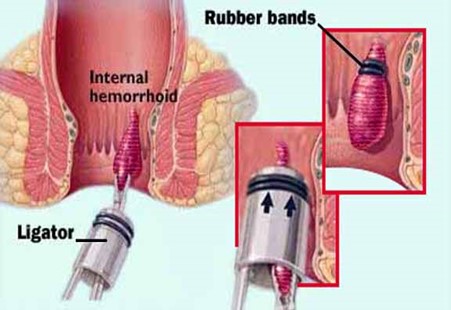 Piles treatment - Rubber band ligation
