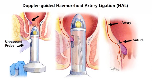 Treatment of piles Doppler guided haemorrhoid artery ligation