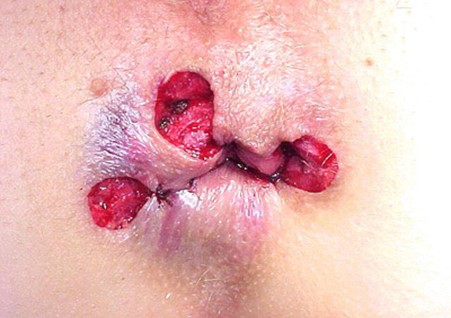 Treatment of piles - Open Haemorrhoidectomy